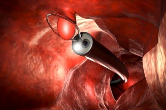 위내시경 금식시간과 전날 먹을 수 있는 음식 및 위내시경 비용 총정리