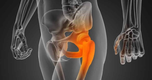 고관절 통증 원인 | 고관절 골절 | 고관절 통증 치료법