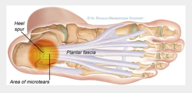 족저-근막염-치료법