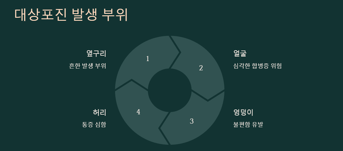 대상포진 발생 부위