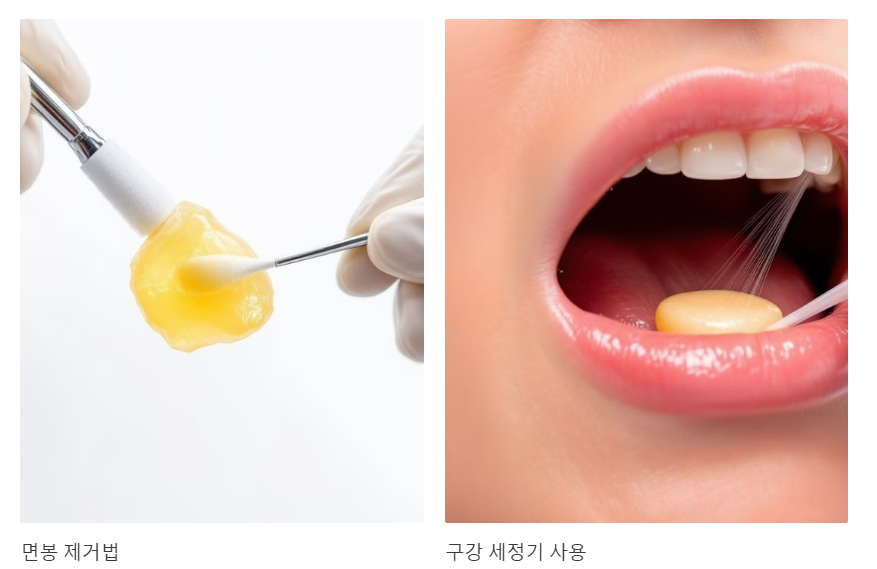 자가제거 방법