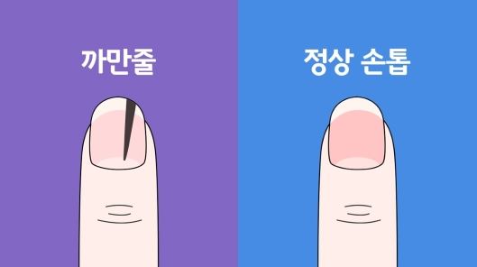 손톱 검은 세로줄무늬