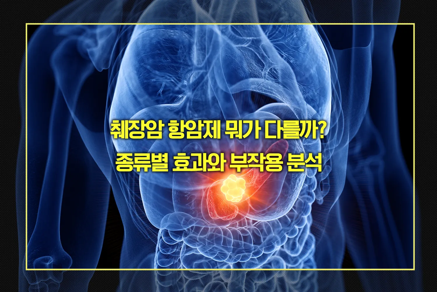 췌장암 항암제 효과와 부작용