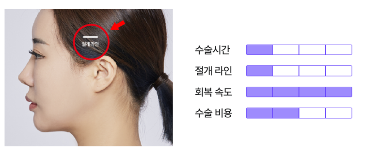 팔자주름수술과 미니리프팅가격