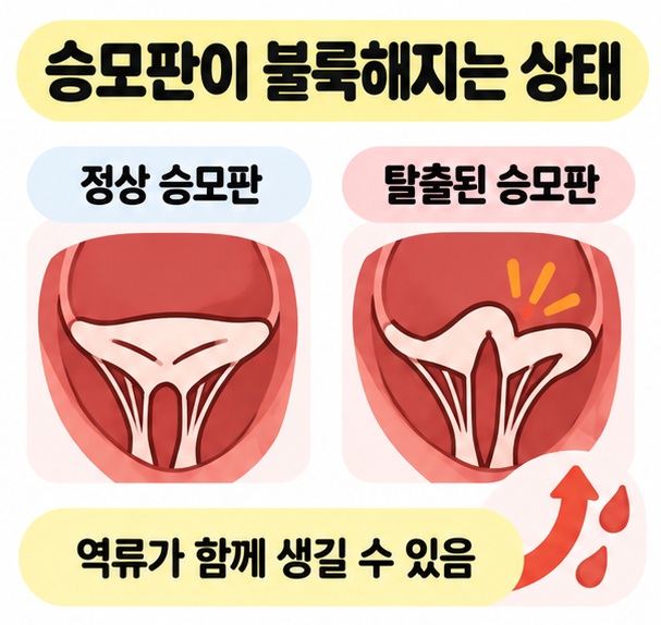 승모판이 좌심방 쪽으로 불룩해지고 일부 혈액이 역류하는 구조를 비교한 카드