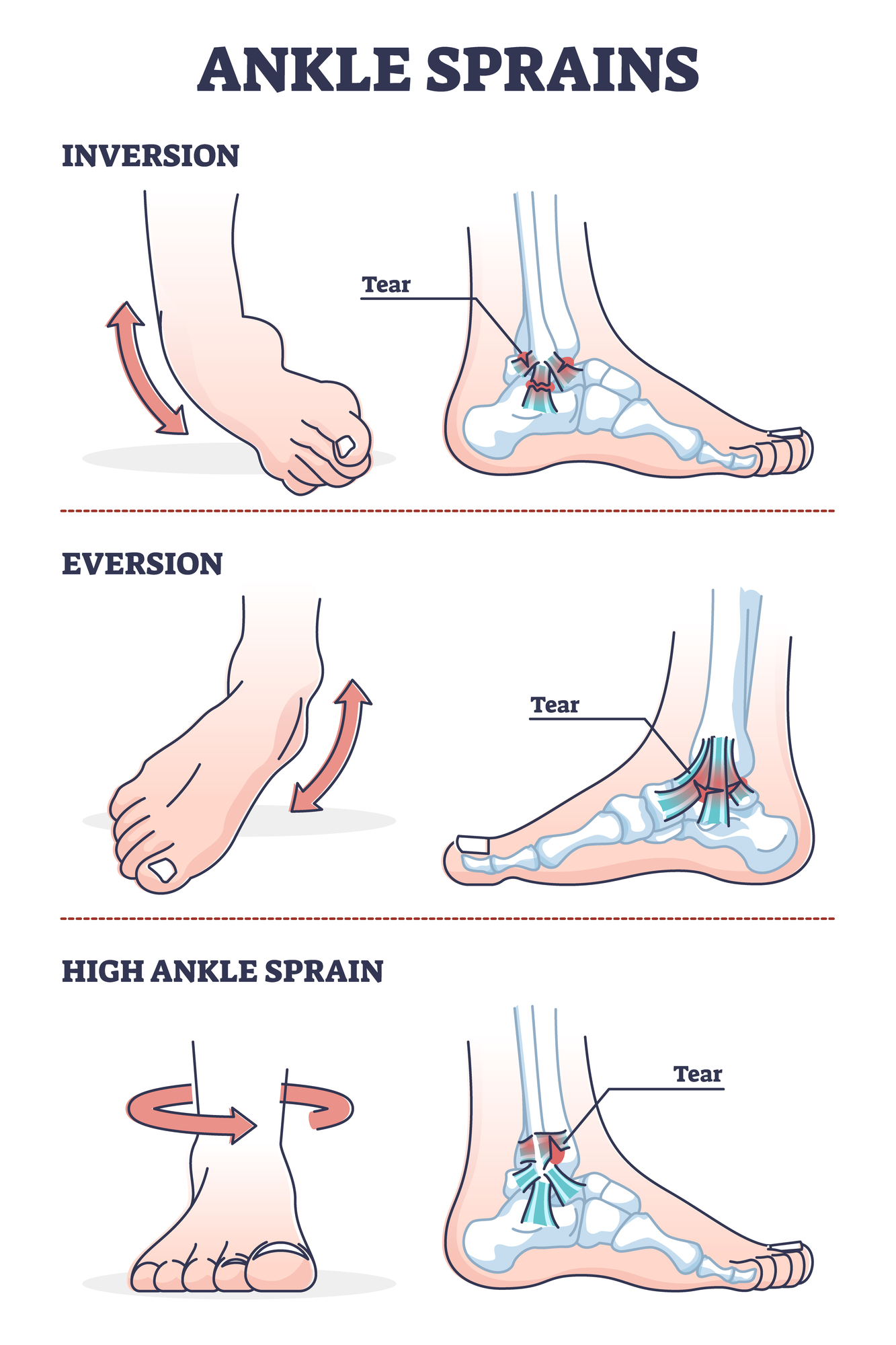 발목염좌-삠-anklesprain