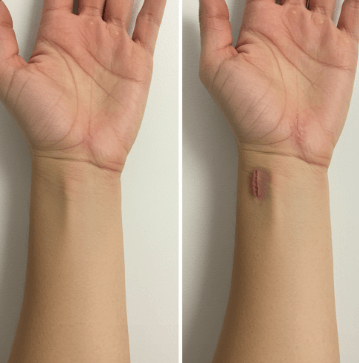 손목터널증후군 증상 및 치료법14