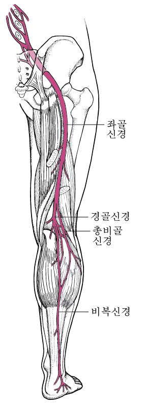 좌골 신경통