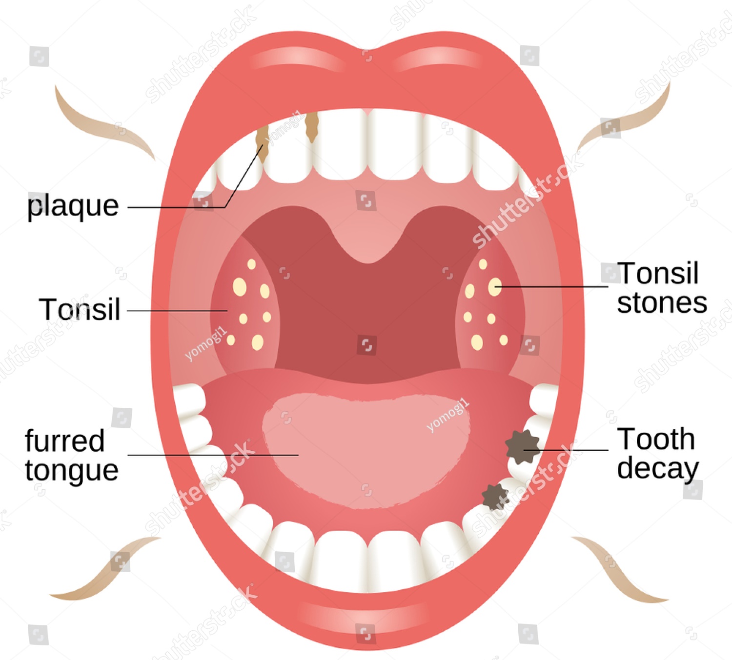 tonsil stones
