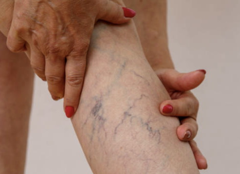 하지정맥류 증상 수술비용 좋은운동 등 총정리(2024 최신)