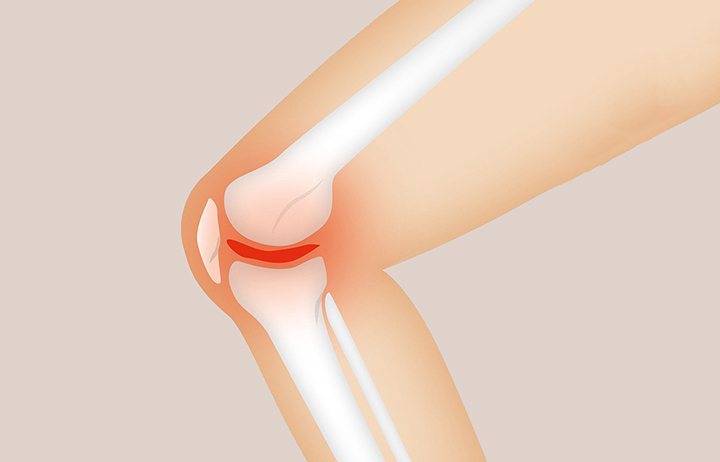 관절염이-심한-무릎