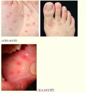 수족구병 증상과 예방 조치 방법 모음_11