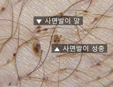 사면발이, 사면바리, 사면발니 사진