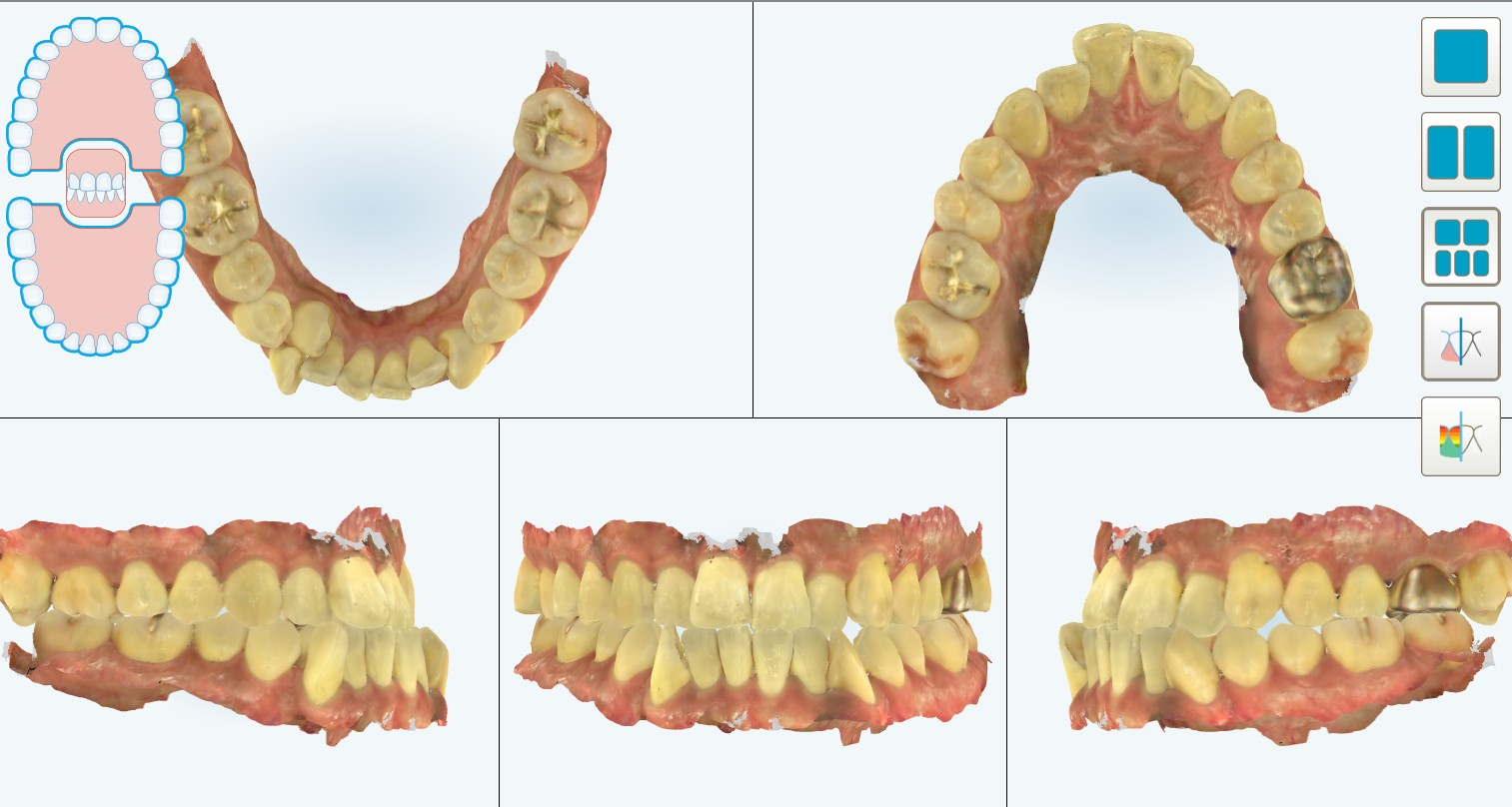 3d 스캔한 교정 전 치아 사진