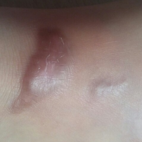 심재성 2도 화상