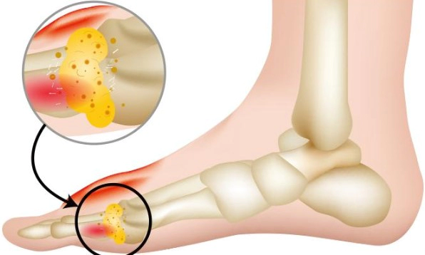 통풍 초기증상 3가지