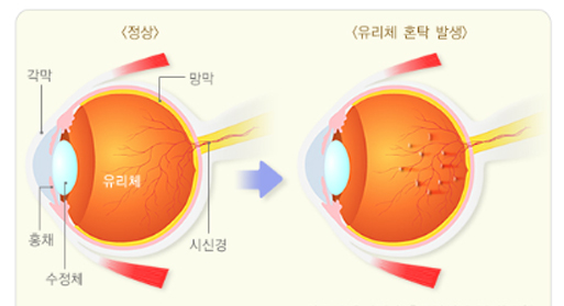 비문증 현상, 눈앞 날파리 치료 방법