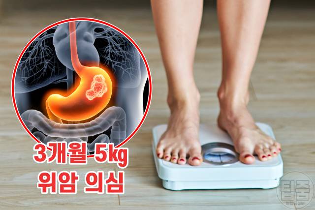 위암 증상,위암 초기증상 자가진단,체중 감소