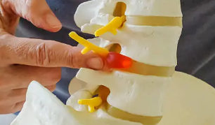 허리디스크 수술