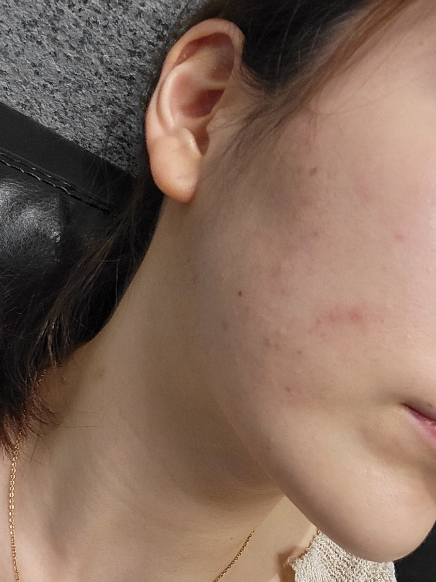 bbl 레이저 후기