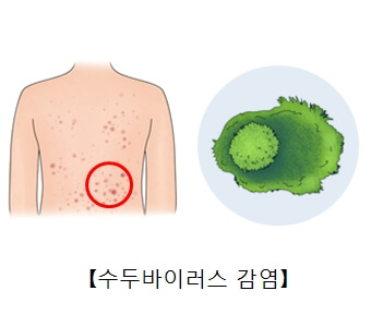 대상포진 전염성에 대해서