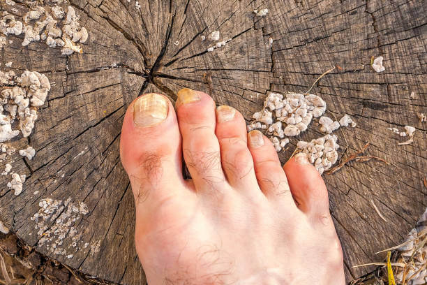 새끼발톱 갈라짐, 원인과 예방방법 때로는 작은 부위에 대한 관심 부족으로 인해 큰 문제가 발생할 수 있습니다. 이번 글에서는 새끼발톱이 갈라지는 이유와 예방 방법, 그리고 집에서 할 수 있는 치료 방법을 참고하시기 바랍니다. 이제부터 새끼발톱에 대한 지식을 쌓아 보세요.