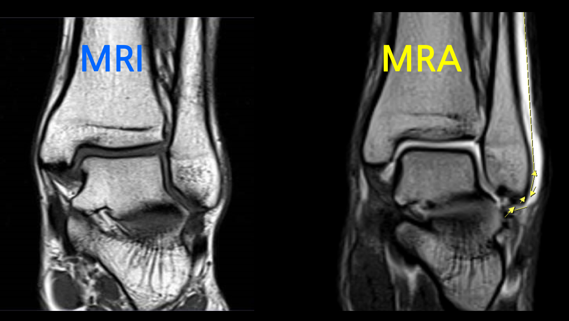 Ankle-MRI-MRA