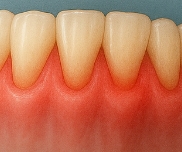 잇몸이 붓고 아플 때