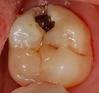 어금니가-깨져-치과에서-치료받는-모습