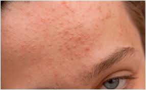 결절성 여드름 치료