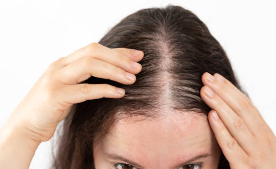 확산성 탈모