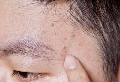 베체트 병 원인 증상