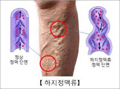 하지정맥류