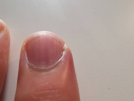 손 거스러미 원인