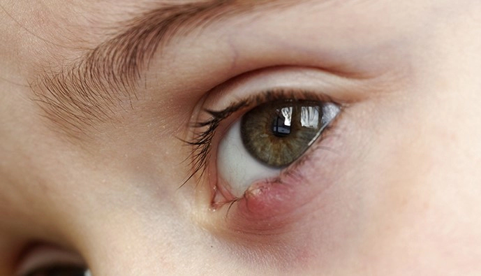 다래끼 초기증상 7가지