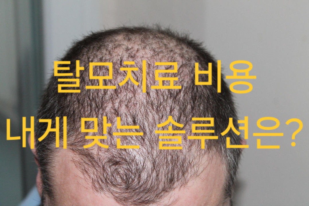 탈모치료-비용-내게-맞는-솔루션은?