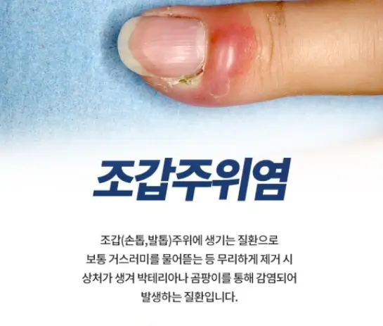 조갑주위염