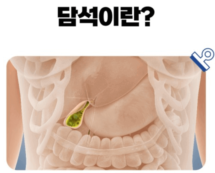 담석증
