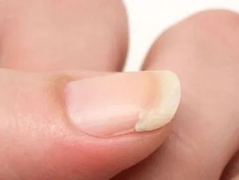 손톱이 갈라지는 이유 원인 증상 대처법_10