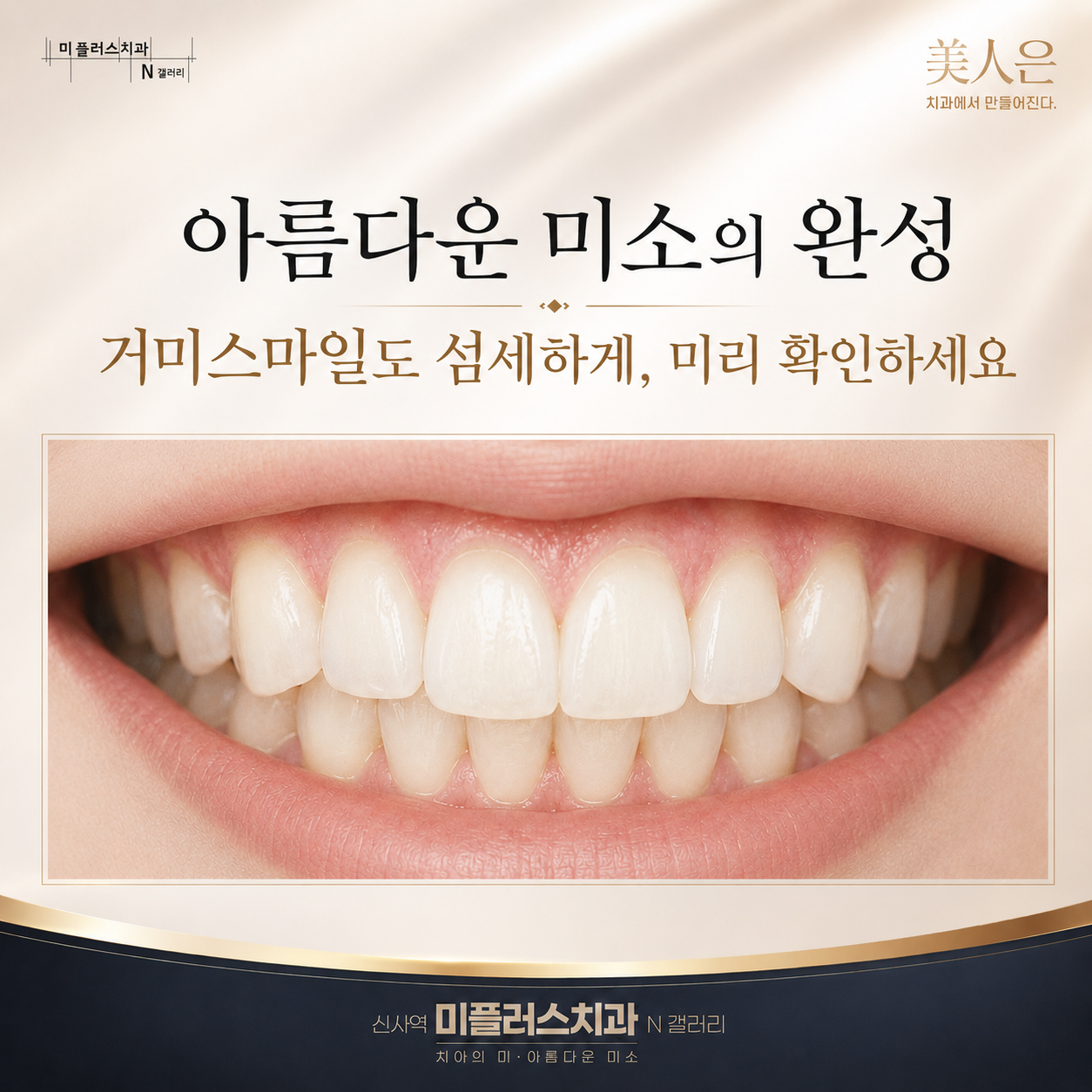 거미스마일과 치아 비율을 고려한 맞춤형 디지털 스마일 디자인 결과