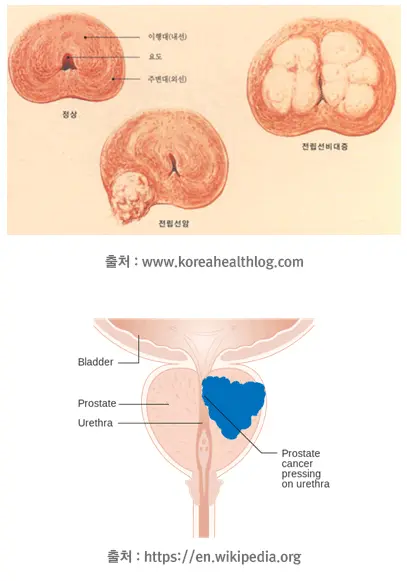 비대증과 암이 발생하는 위치가 다르다는 것을 색상으로 구분해 주는 이미지