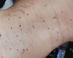 편평사마귀 없애는 방법