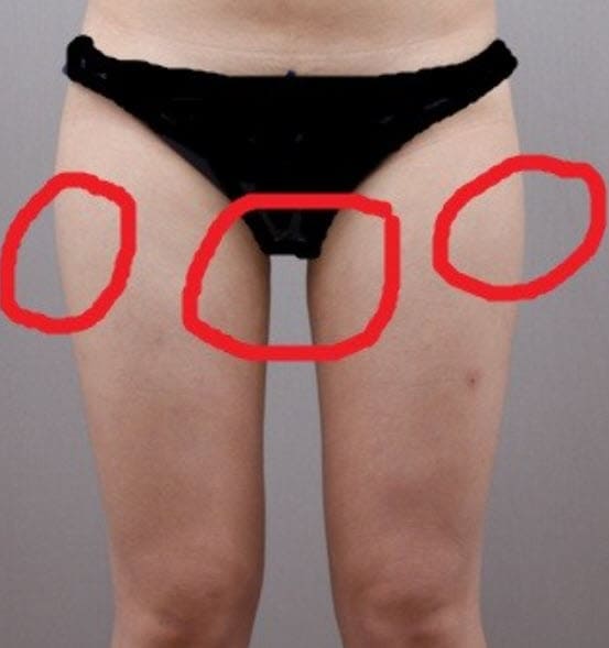 허벅지살 지방흡입 사진
