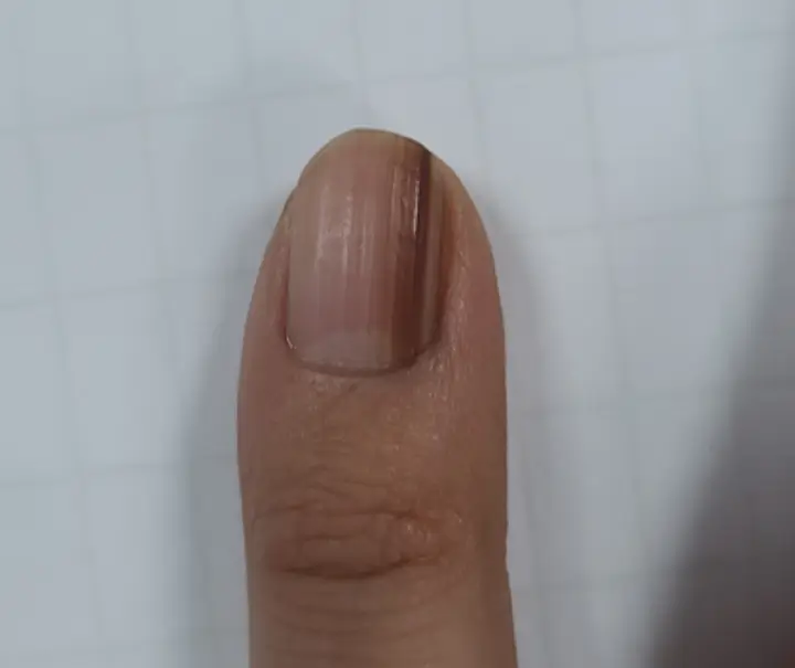 흑색종
