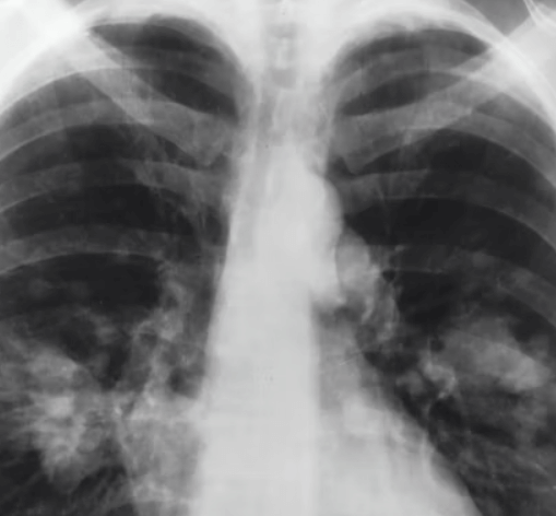 공황장애 초기증상 - 과호흡