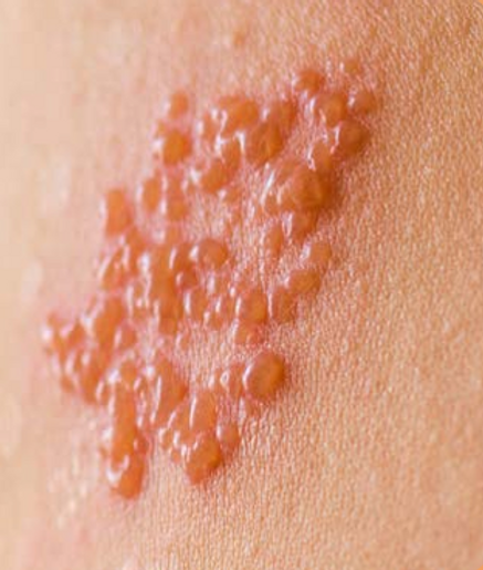 대상포진 예방접종 가격 (+ 최저가&amp;#44; 무료접종)