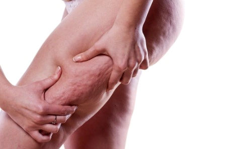 셀룰라이트란 정확한 뜻과 사진