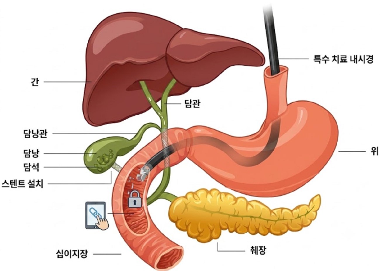 담낭과-담도를-지켜라-