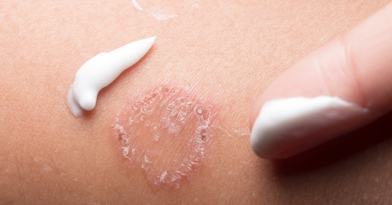 건선에 연고를 바르는 모습