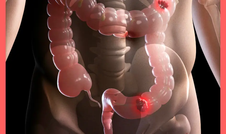 크론병 원인과 증상